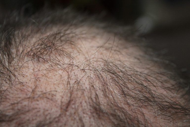 Close-up of thinning hair on a scalp with sparse dark strands and visible skin