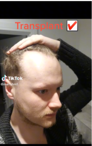Person touching a shaved scalp, with “Transplant” text and a check mark at the top.