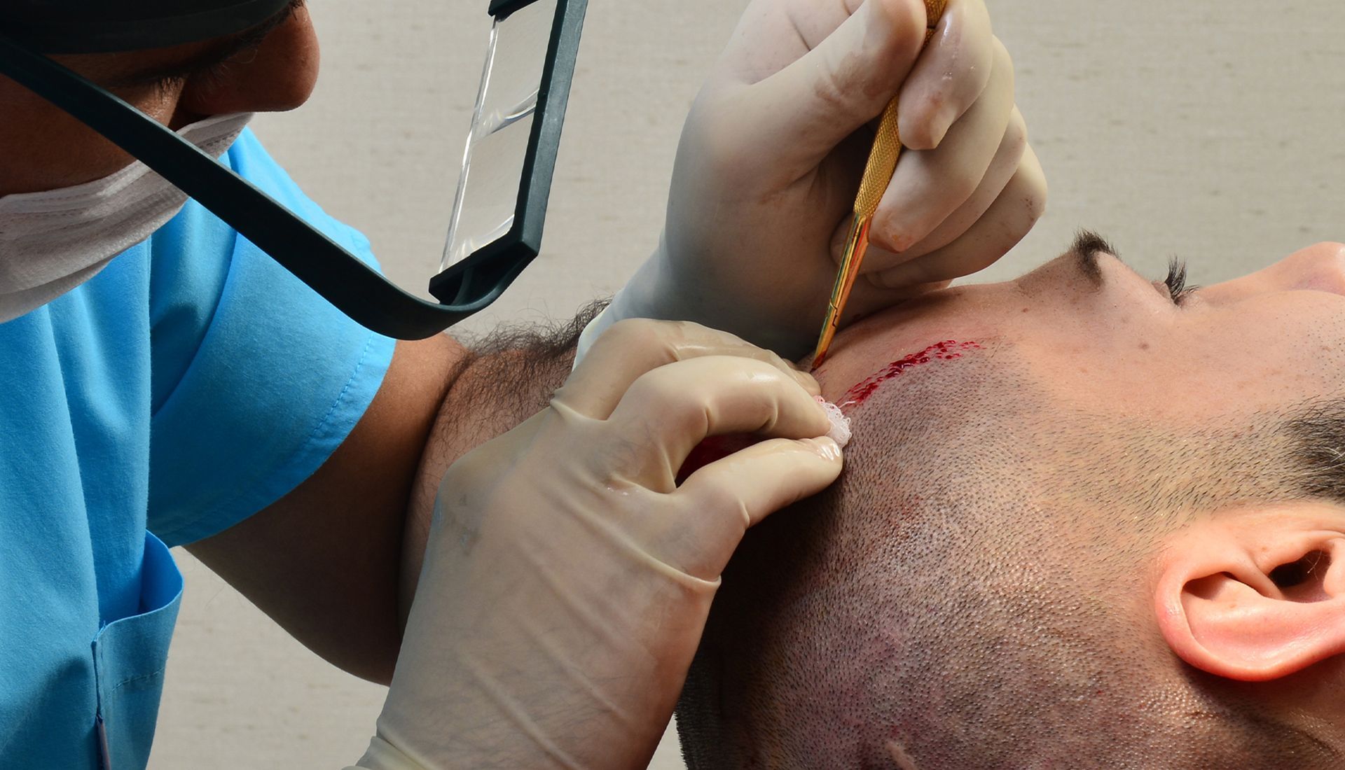 FUE Hair Transplant Surgery