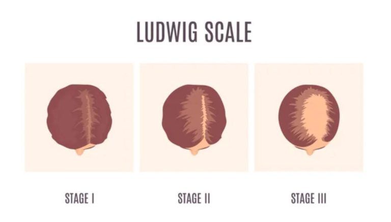 Ludwig scale showing three stages of hair loss with brown hair illustrations labeled Stage I, II, and III