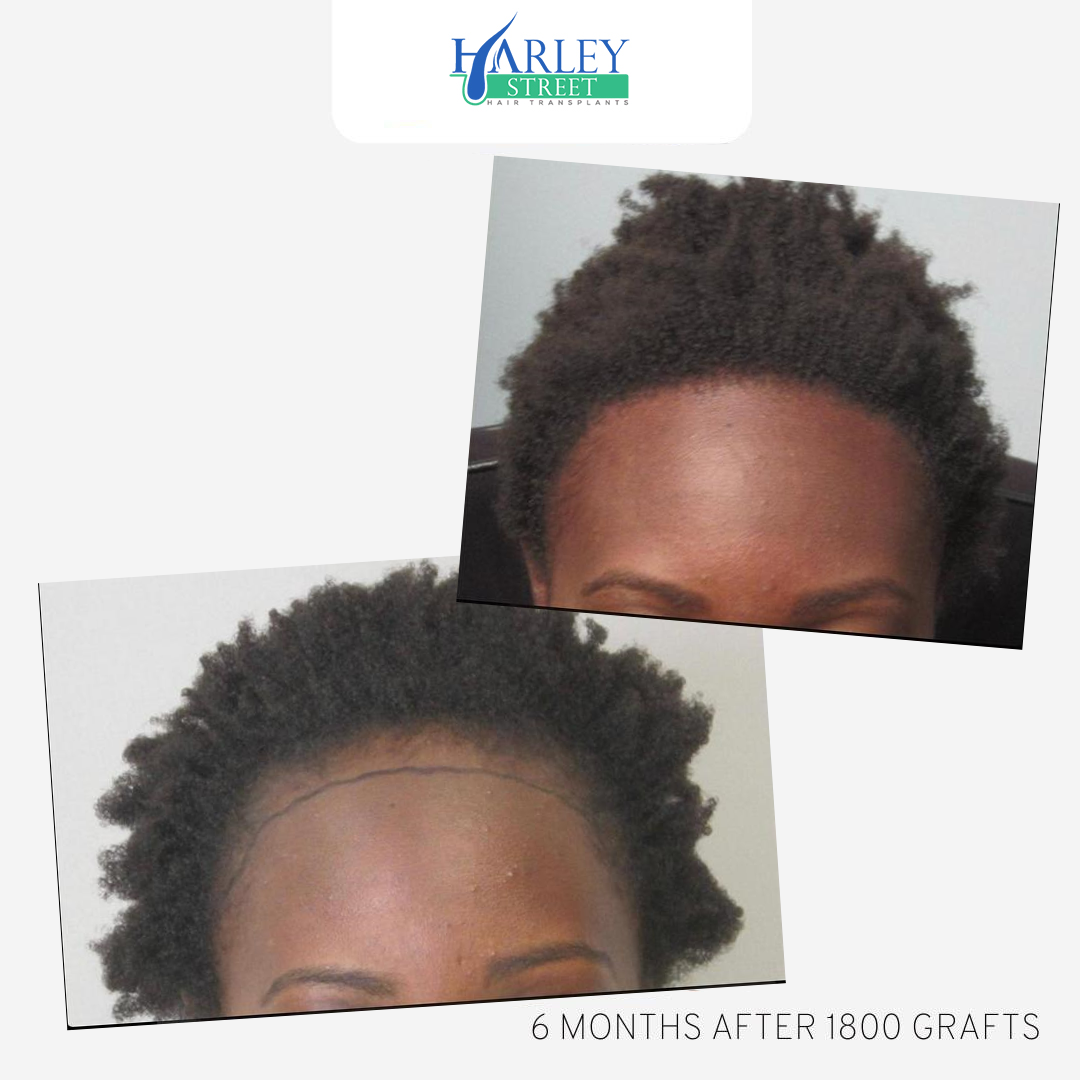Afro textured hair transplant six-month result