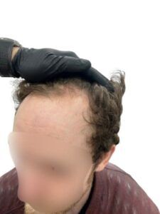 Hairline being assessed as a potential recipient area