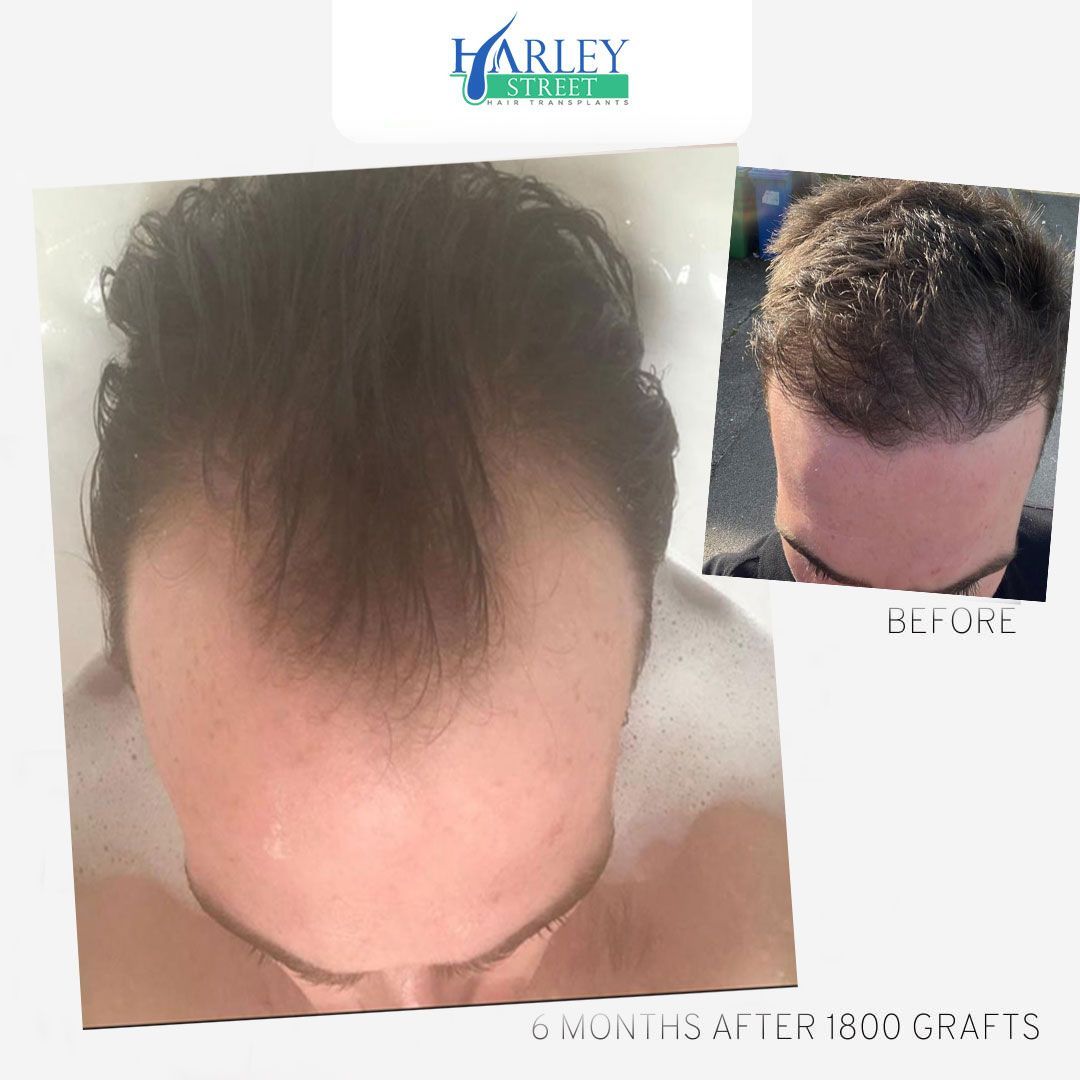 Widow’s peak hair restoration result