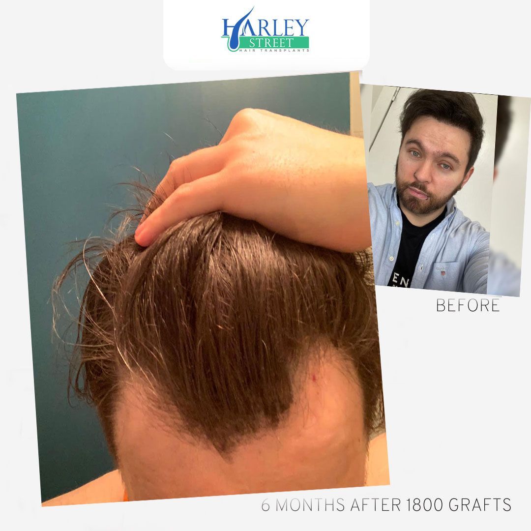 Widow's peak hairline transplant result