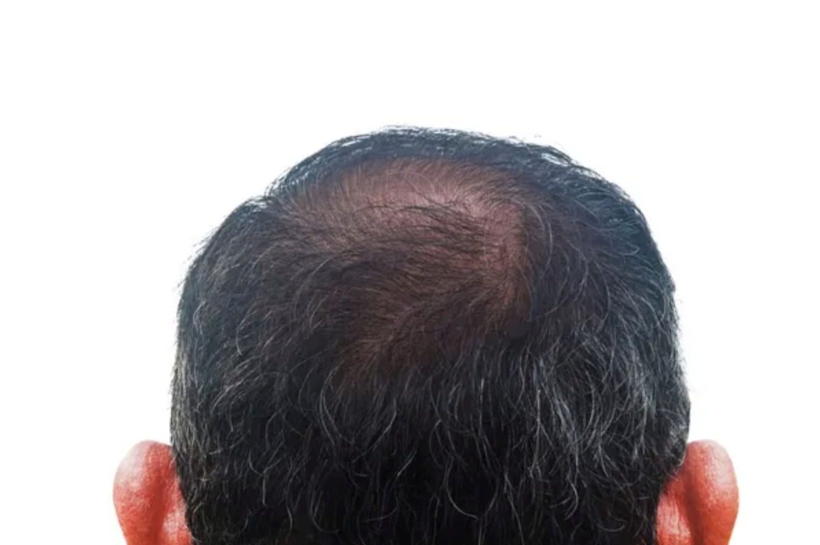 Back of a person’s head with thinning hair on top and dark hair around the sides