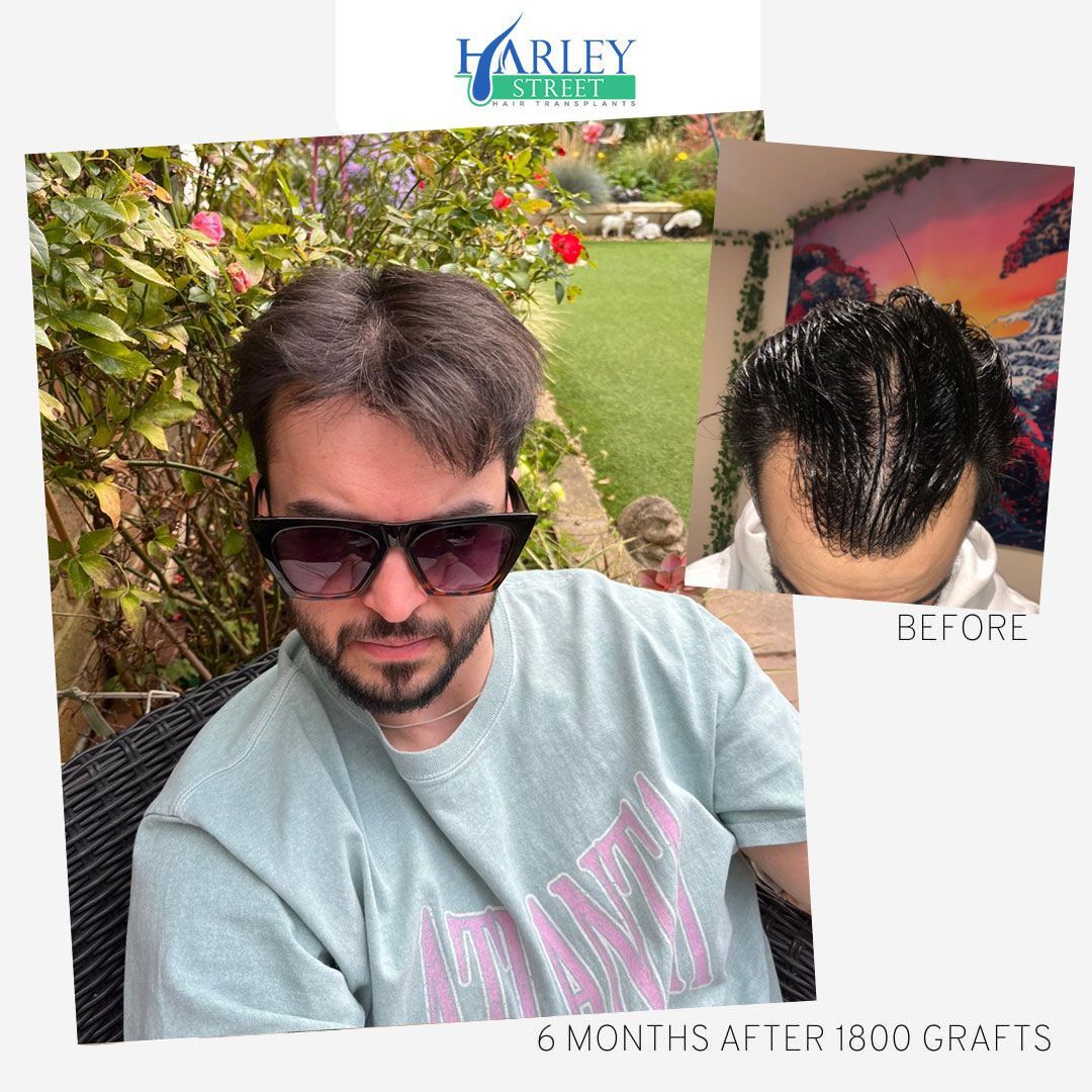 Hairline transplant patient result