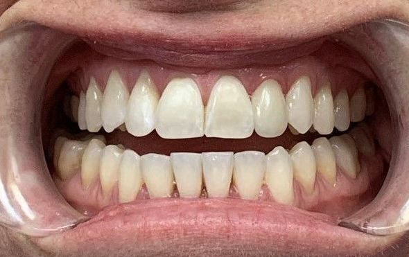 Close-up of a smiling mouth with braces on the upper teeth and no braces on the lower teeth