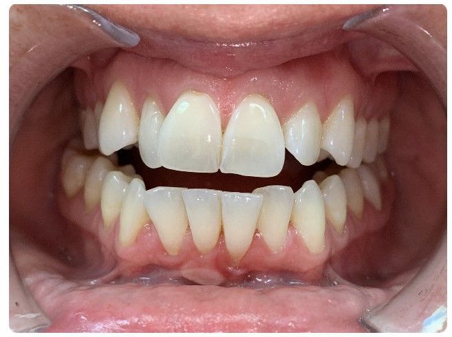 Open mouth showing upper and lower teeth with a noticeable gap between the front teeth