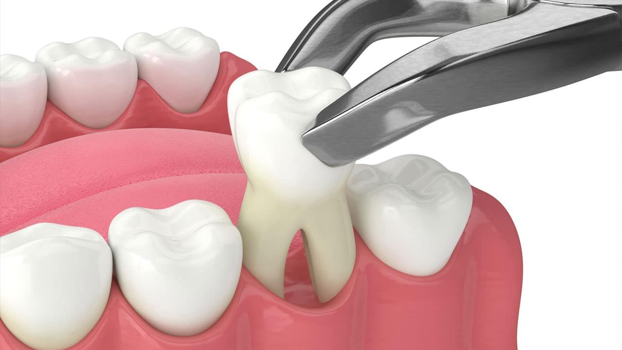 Tooth Removal | Aurora, IL | Prairie Point Dental Tooth Removal | Aurora, IL | Prairie Point Dental