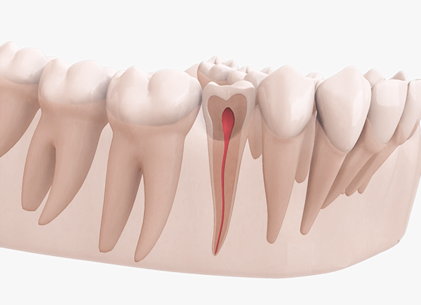Root Canal | Aurora, IL | Prairie Point Dental