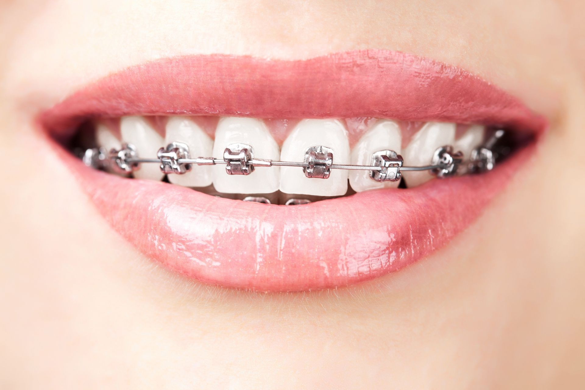 Close-up of smiling lips with silver braces on white teeth