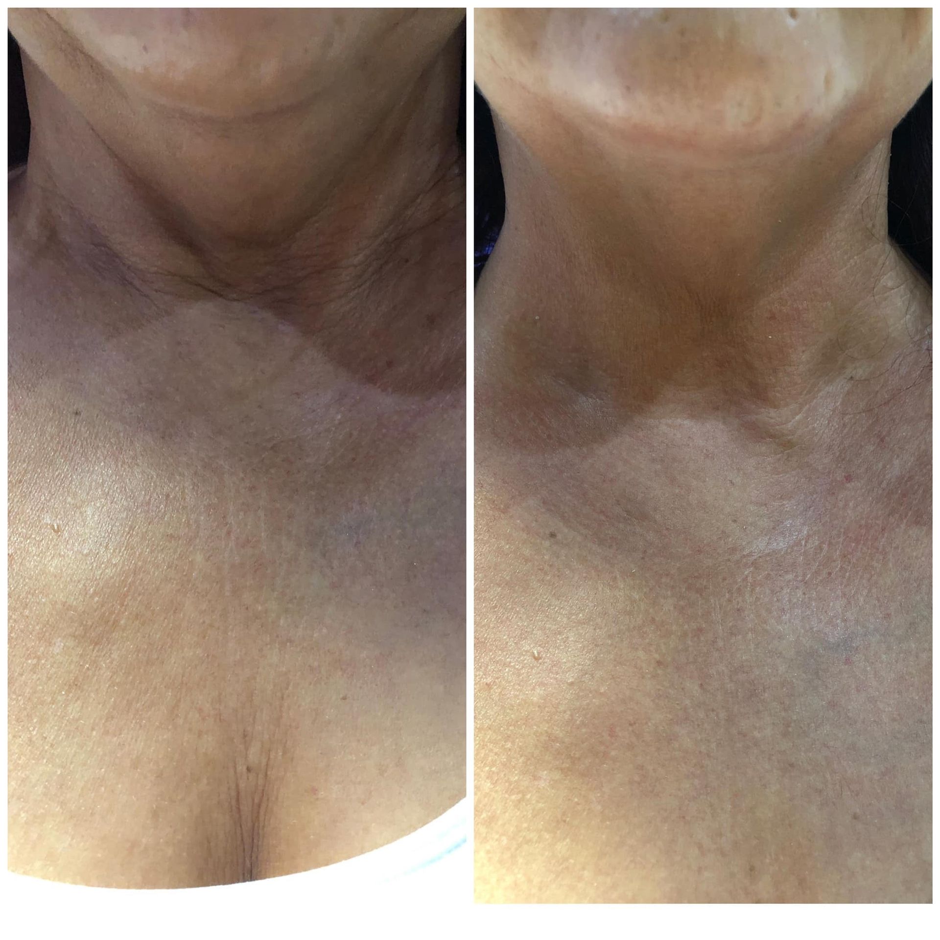 Tone body fat — Spring Park, MN — Skingevity Med Spa