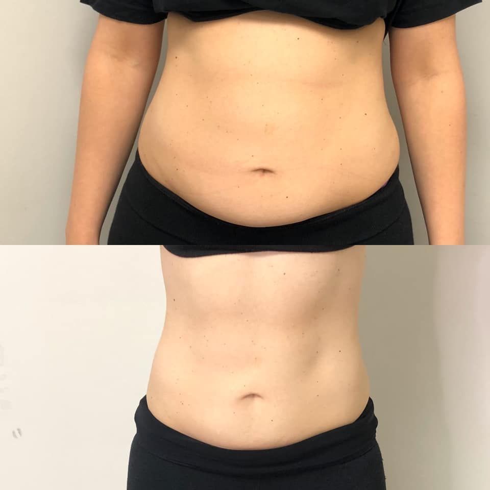 Body Slimming treatment — Spring Park, MN — Skingevity Med Spa