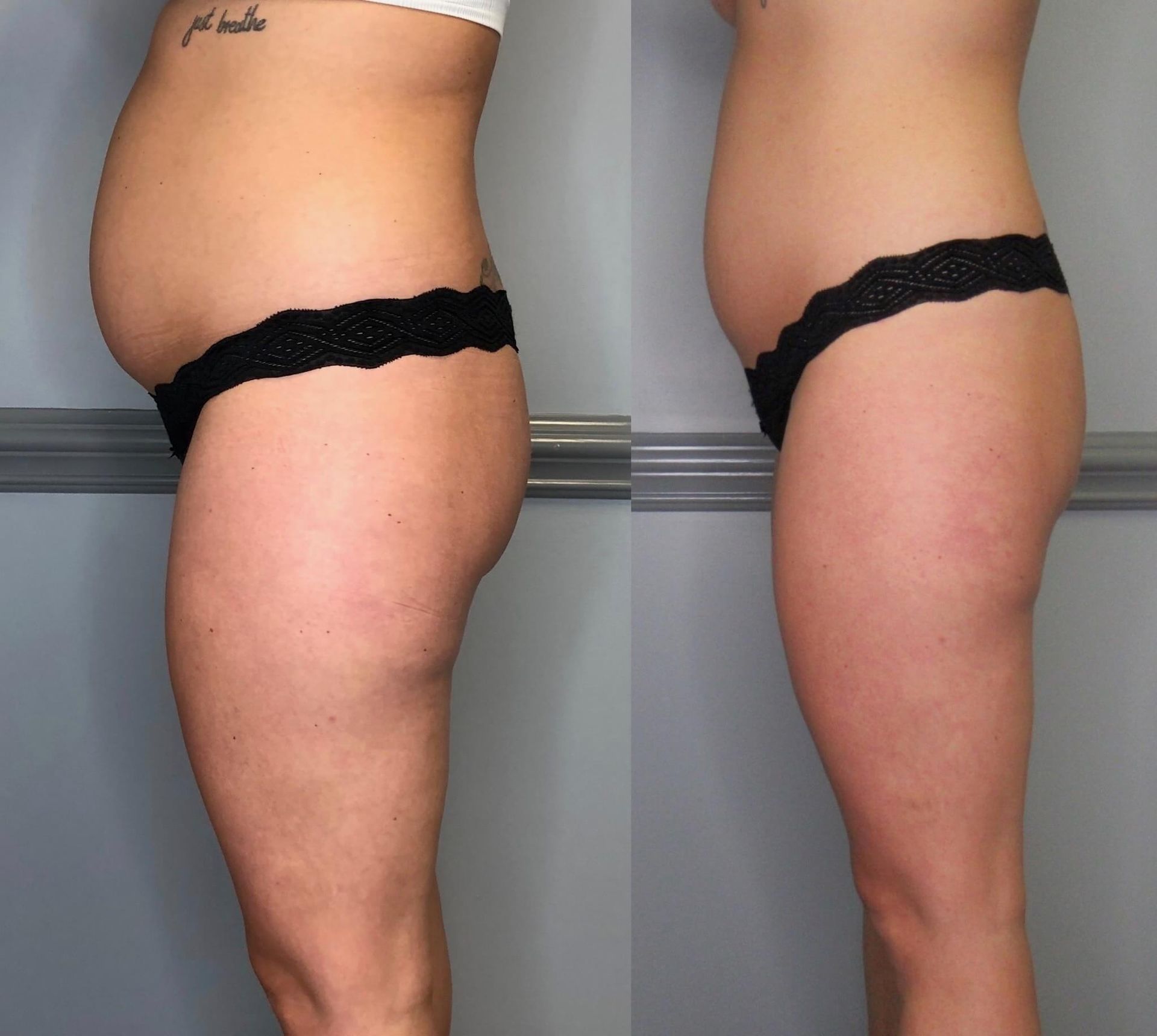 Before and after cryoskin treatment — Spring Park, MN — Skingevity Med Spa