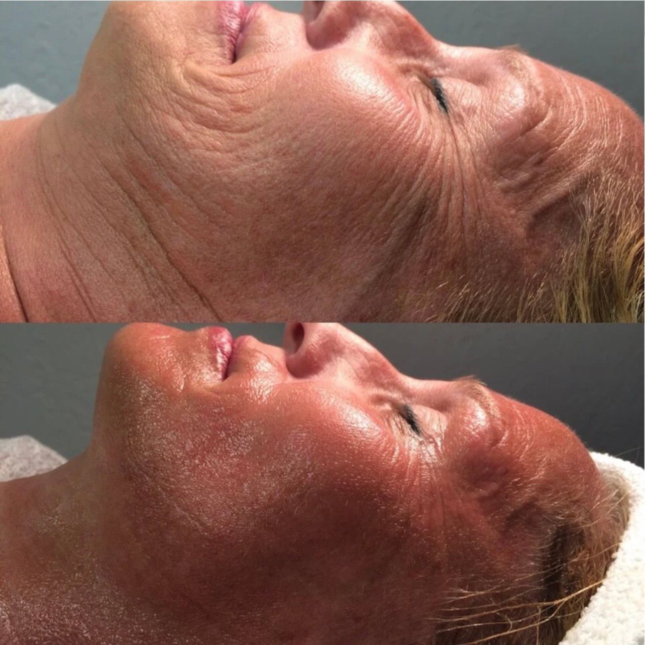 Cryoslimming — Spring Park, MN — Skingevity Med Spa