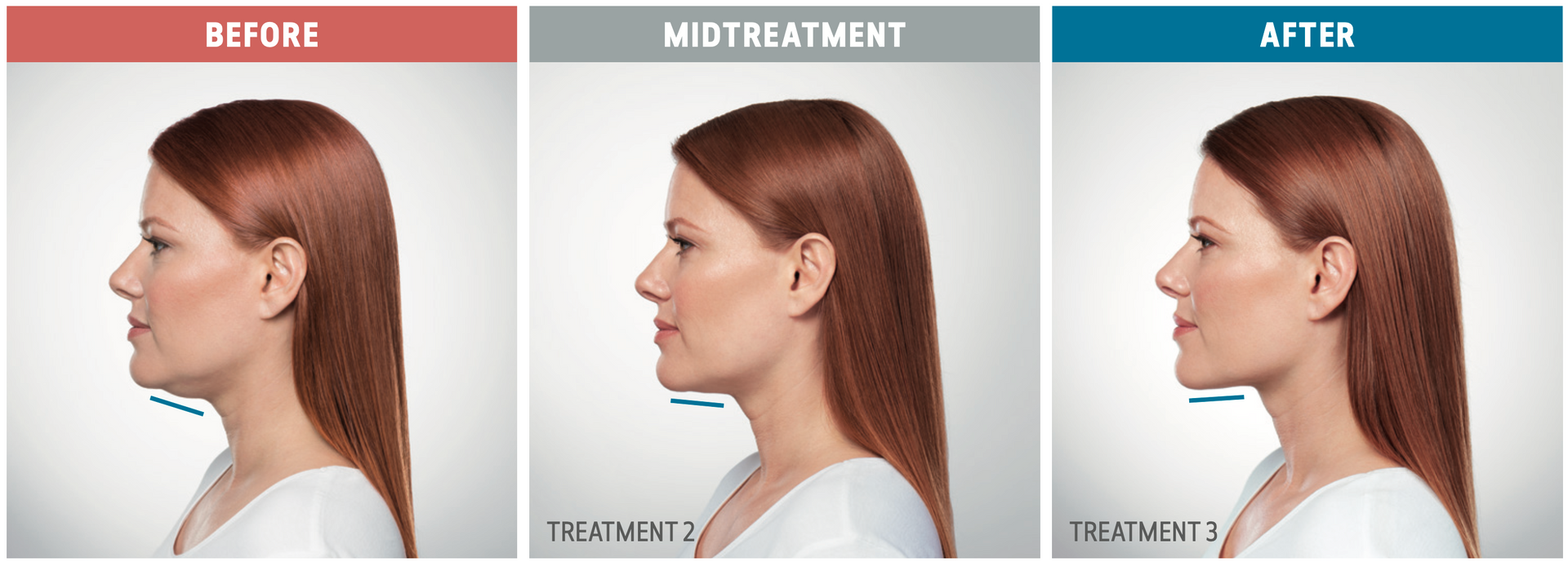 Results with KYBELLA — Spring Park, MN — Skingevity Med Spa