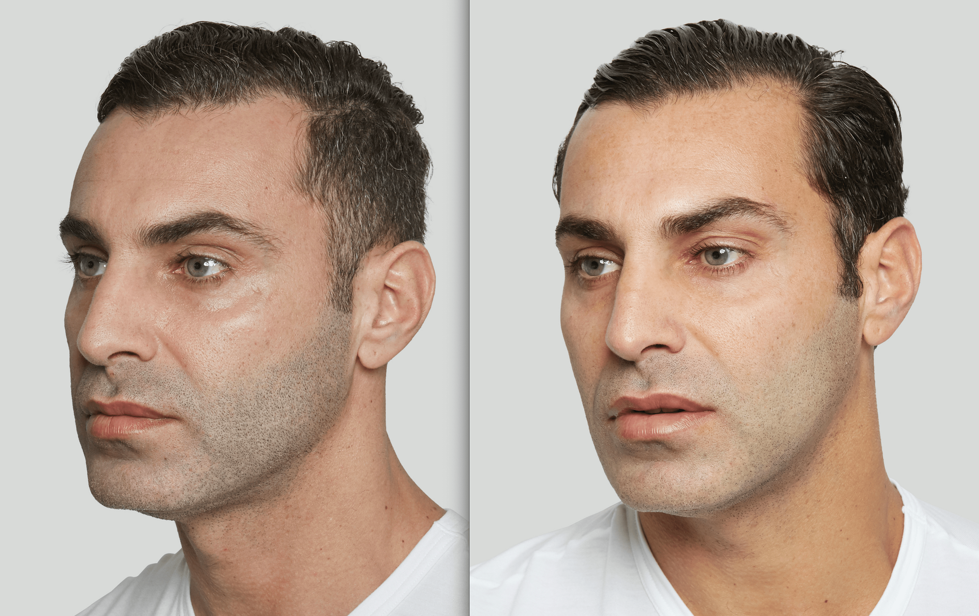 Results with Sculptra — Spring Park, MN — Skingevity Med Spa