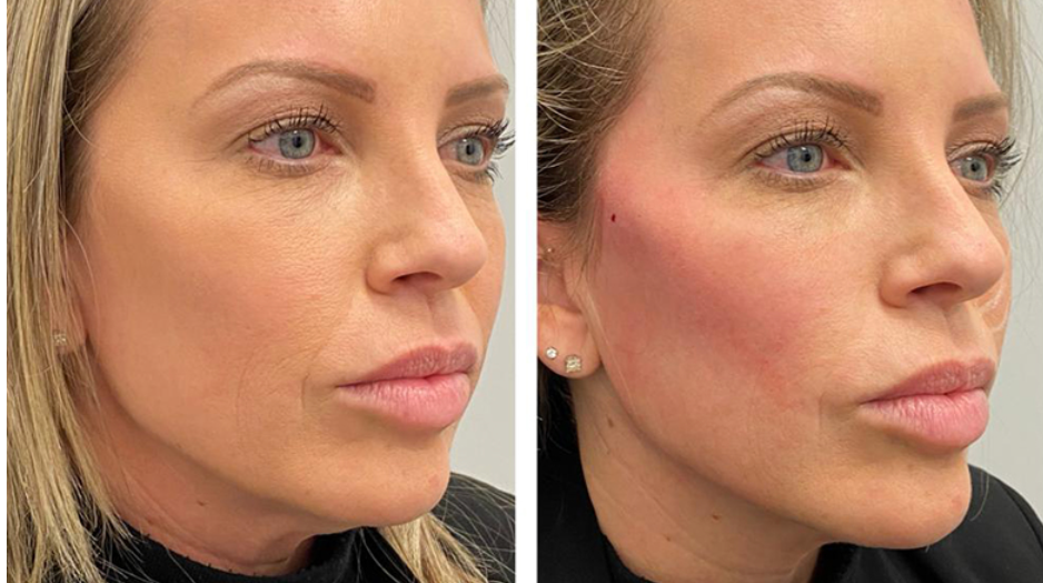 Results with Threadlift — Spring Park, MN — Skingevity Med Spa