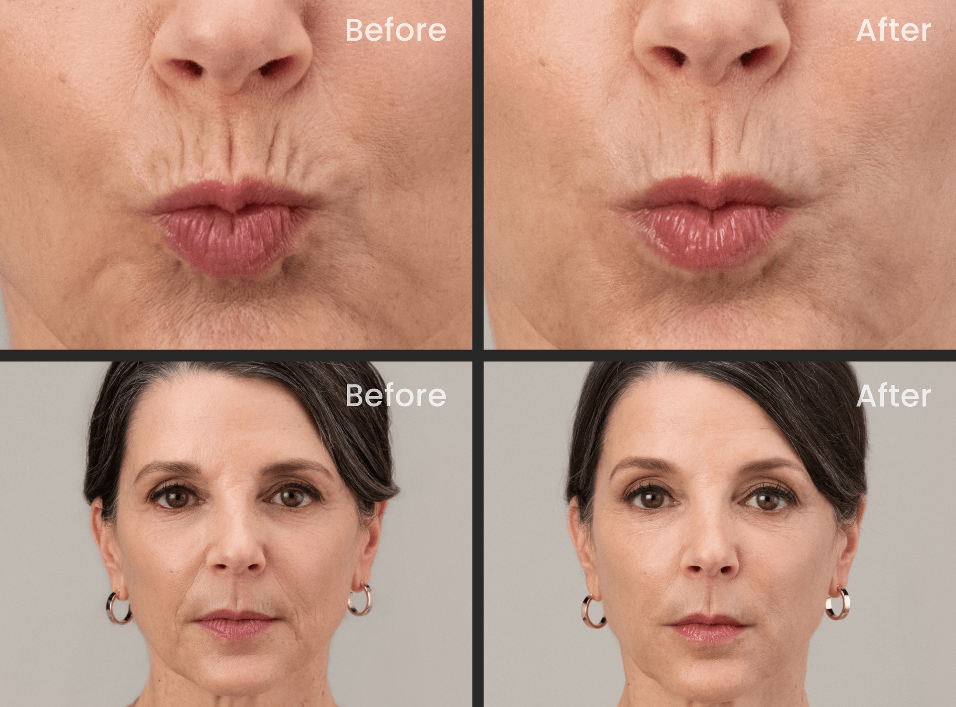 RHA Filler Treatment — Spring Park, MN — Skingevity Med Spa