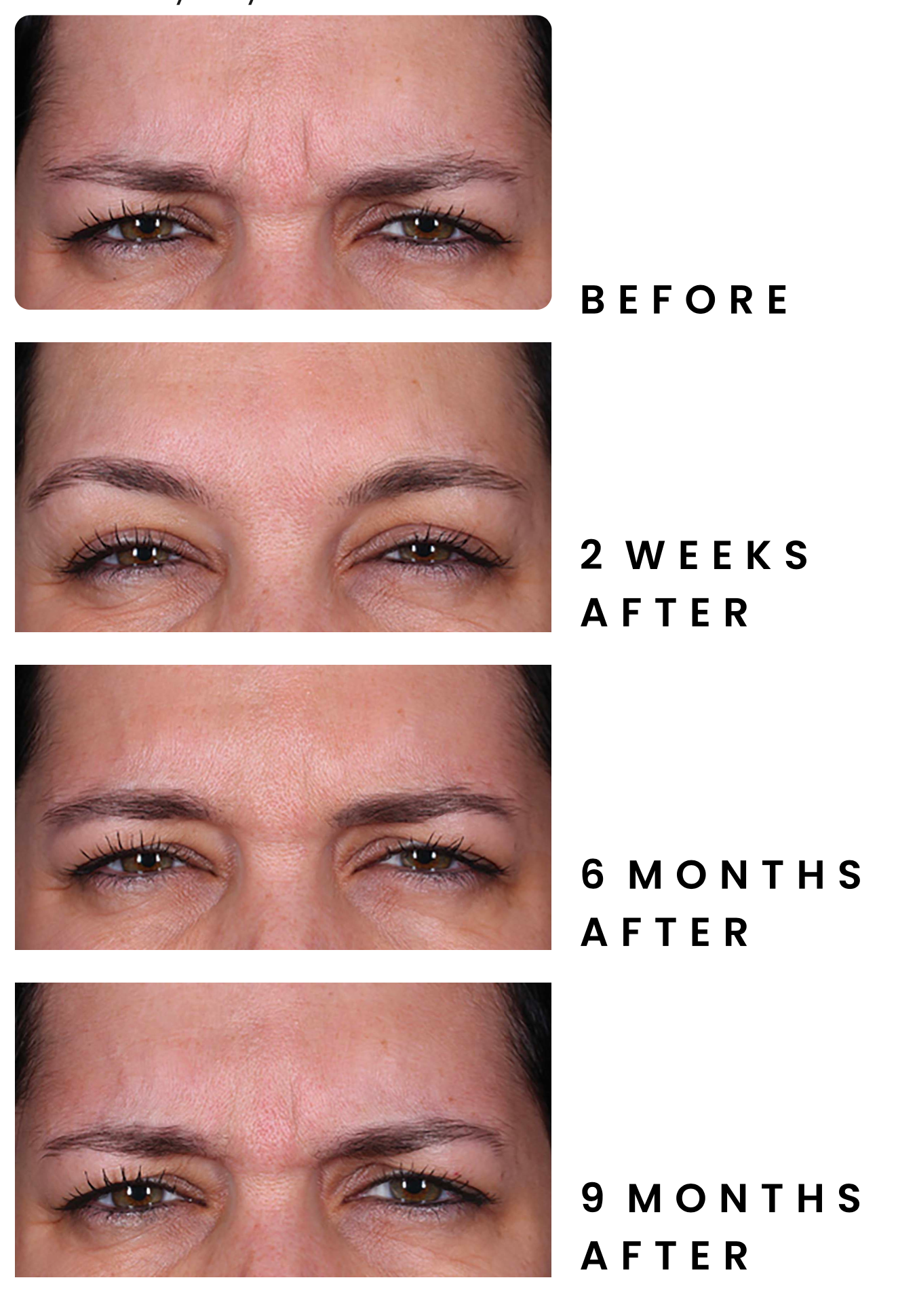 DAXXIFY Treatment — Spring Park, MN — Skingevity Med Spa