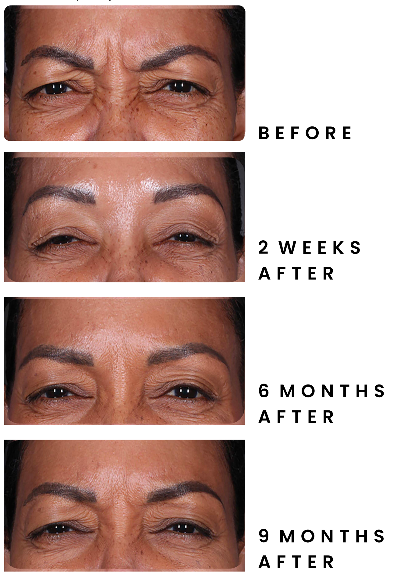 Results with DAXXIFY — Spring Park, MN — Skingevity Med Spa