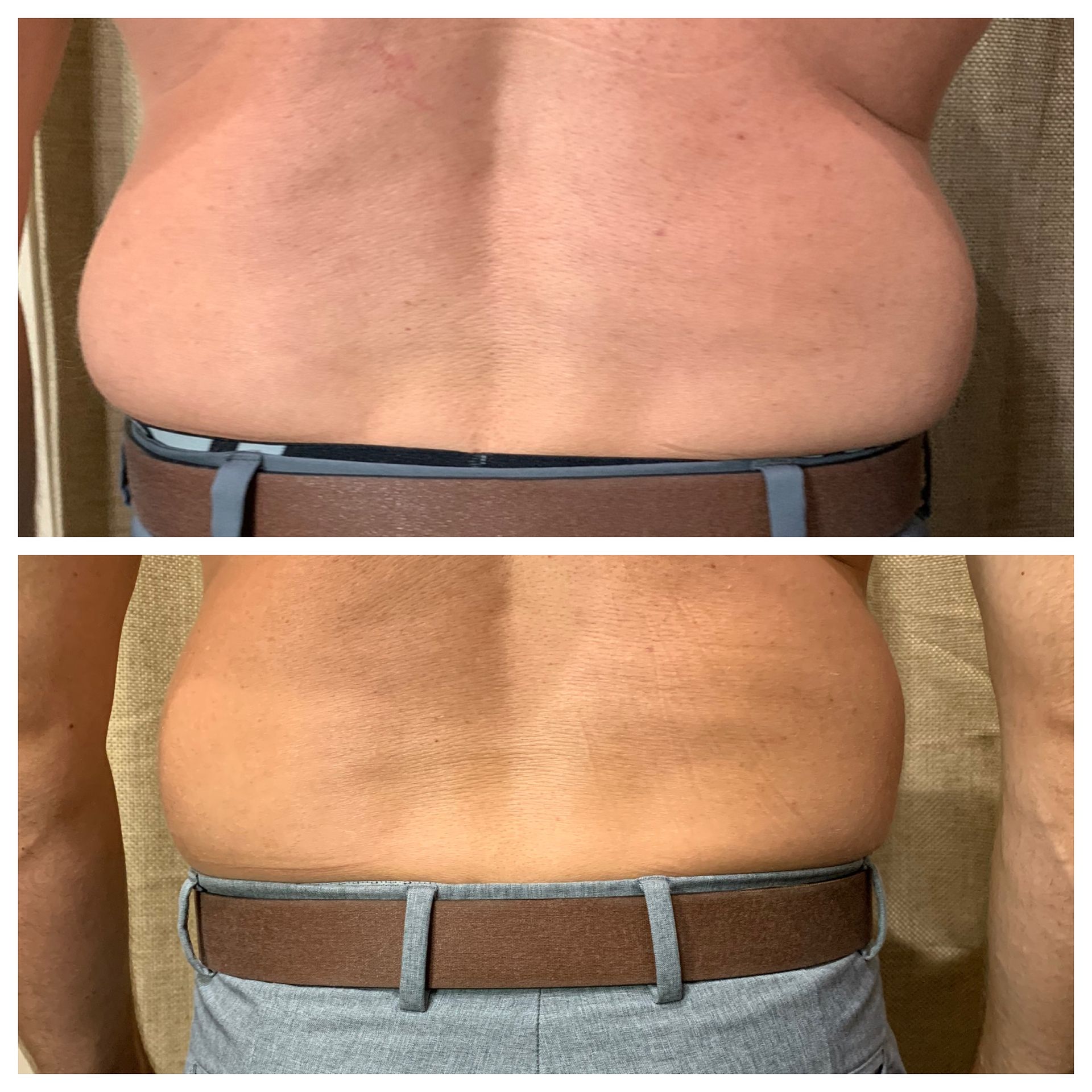 Slimming Treatment — Spring Park, MN — Skingevity Med Spa