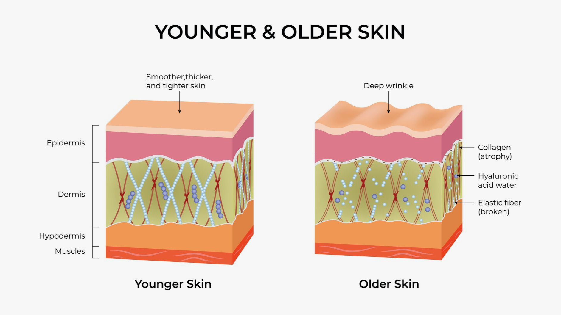 Diagram comparing younger and older skin layers, showing thinner, wrinkled older skin on the right.