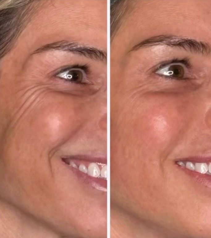 Side-by-side close-up of a smiling woman's face, showing before-and-after skin texture comparison