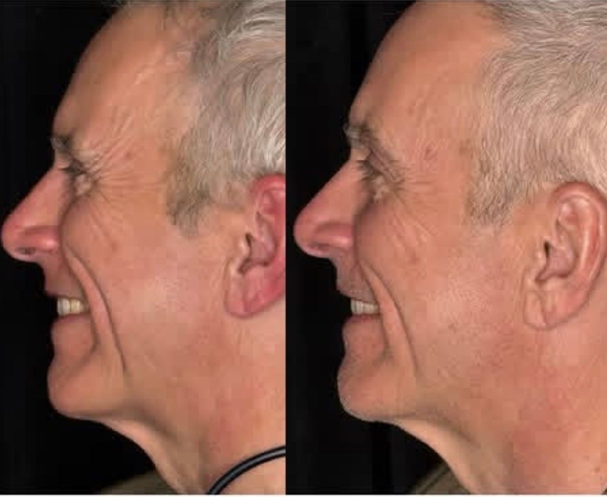 Side-by-side profile photos of a smiling older man, showing a before-and-after facial change
