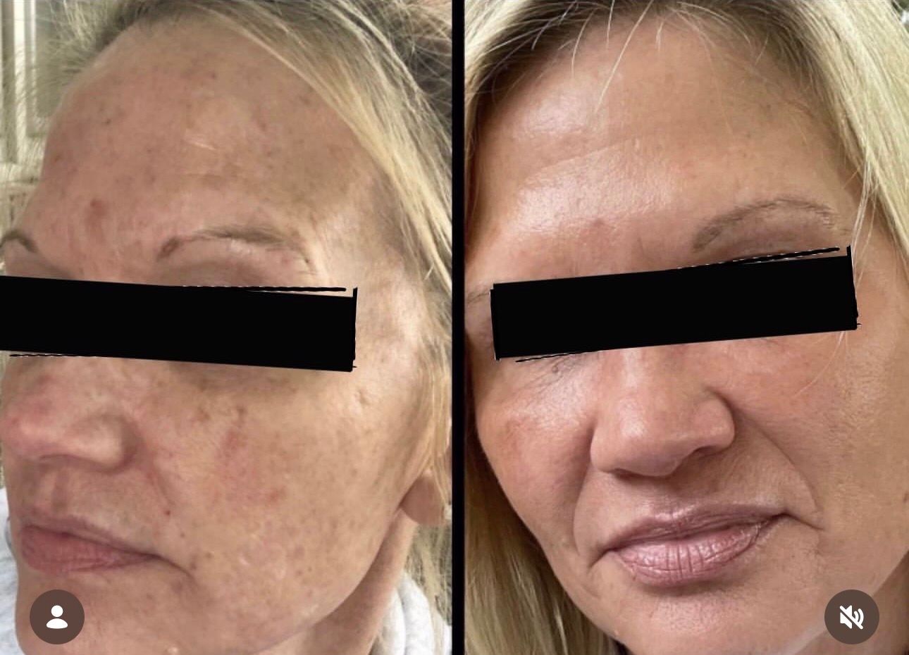 Side-by-side close-up facial photos showing a woman’s face before and after treatment.