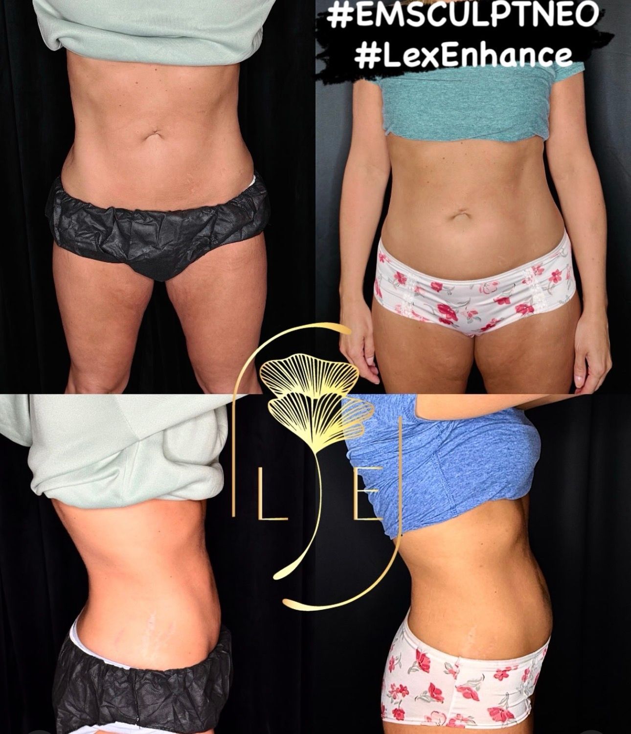 Before-and-after side view of torso slimming results with black-and-white underwear on a collage background.