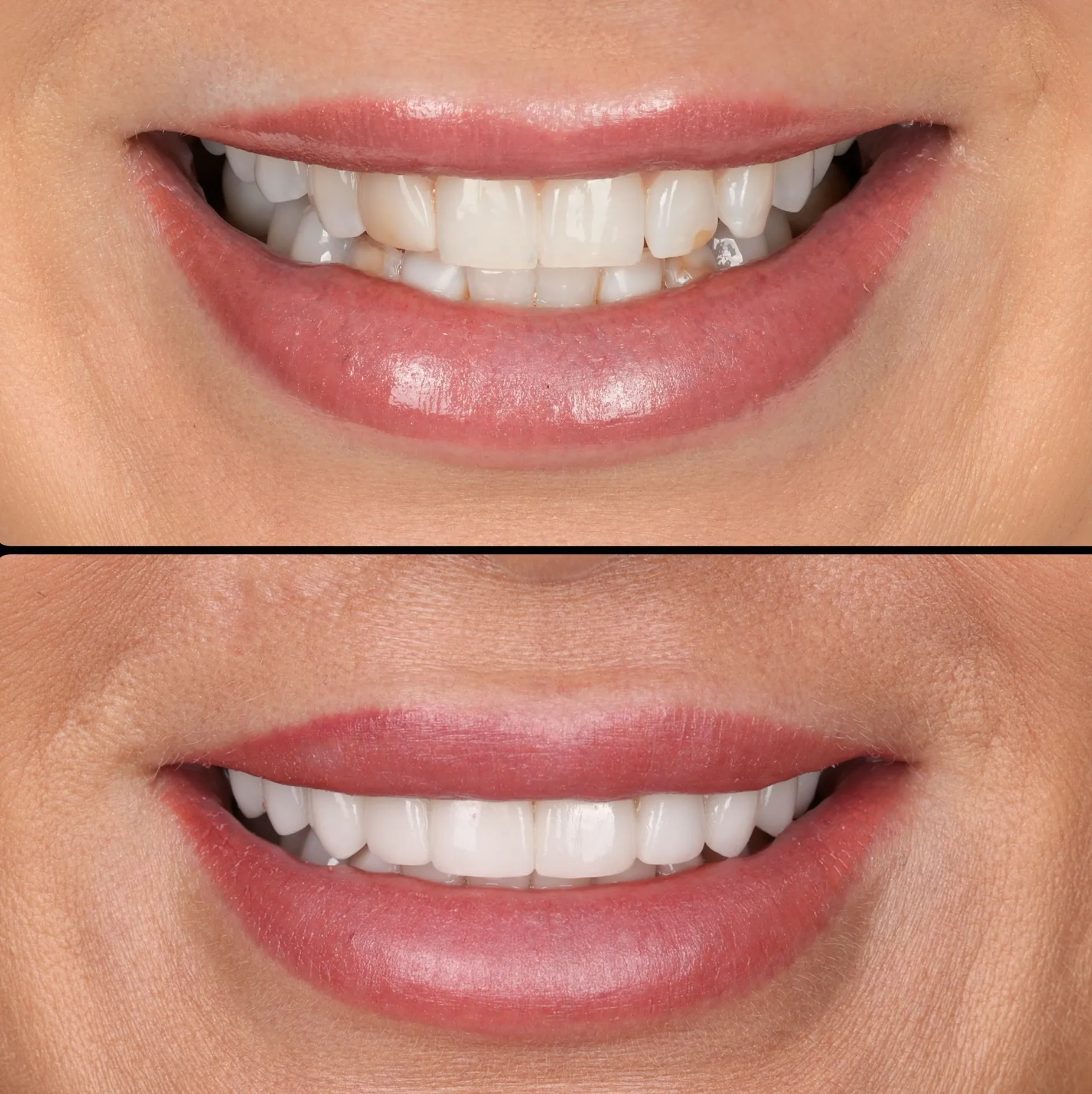 Close-up before-and-after of a smiling mouth, showing teeth alignment improvement