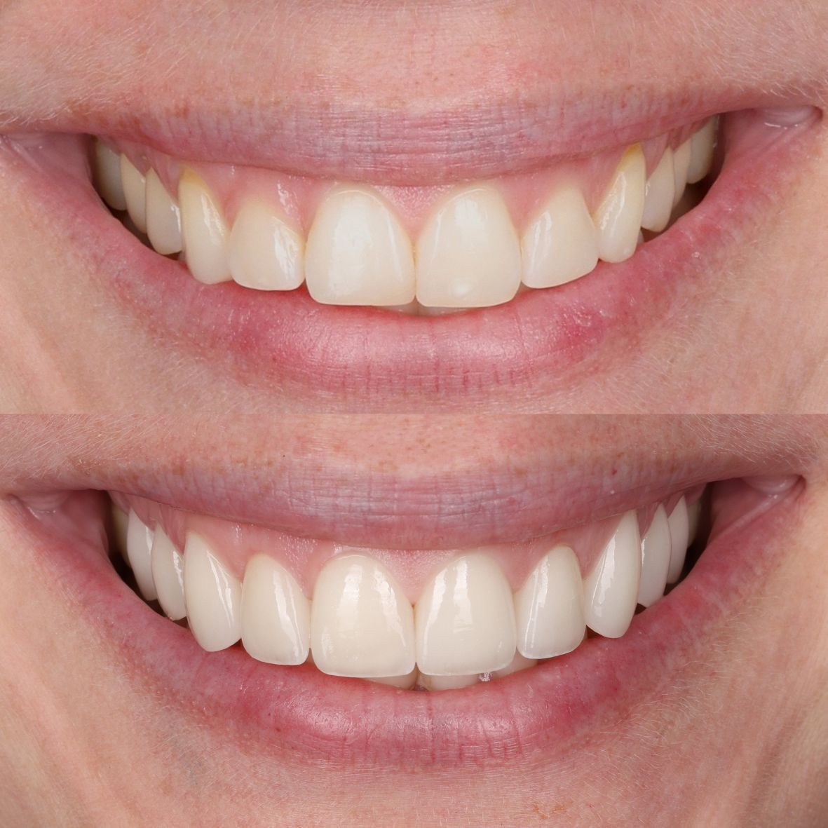Close-up of a smiling mouth with white teeth and glossy pink lips, shown in two stacked views.