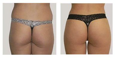 buttock augmentation