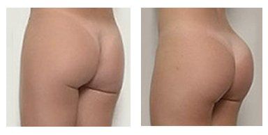 buttock augmentation