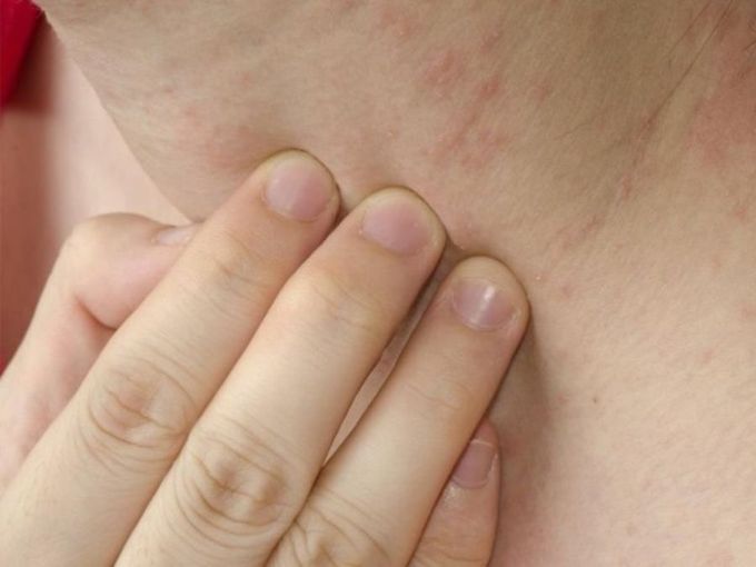 Psoriasi sul collo