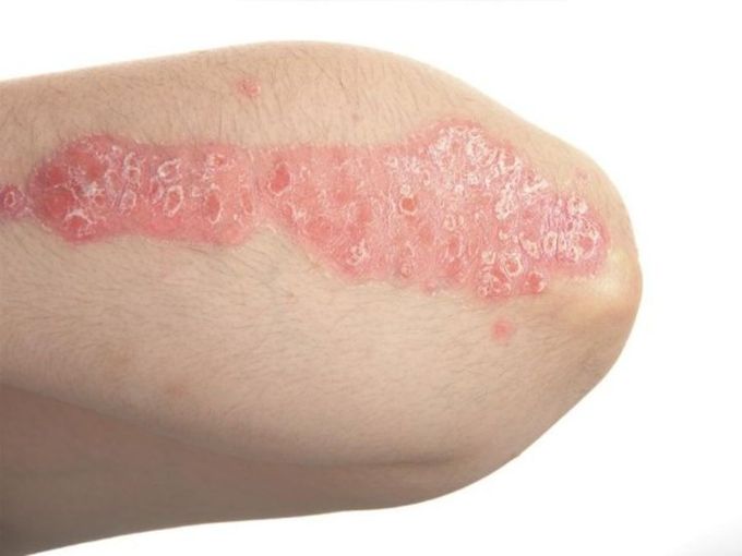 Psoriasi sul corpo
