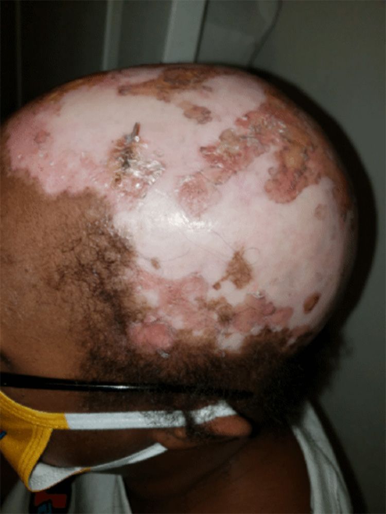 Lupus