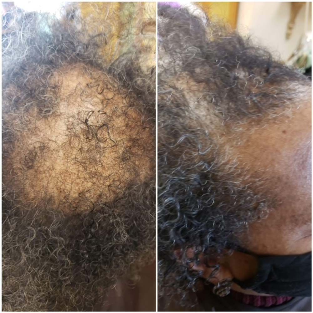 Hair Growth Results