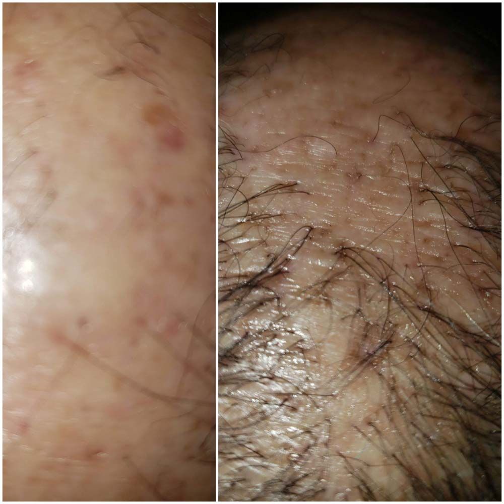 Hair Growth Results