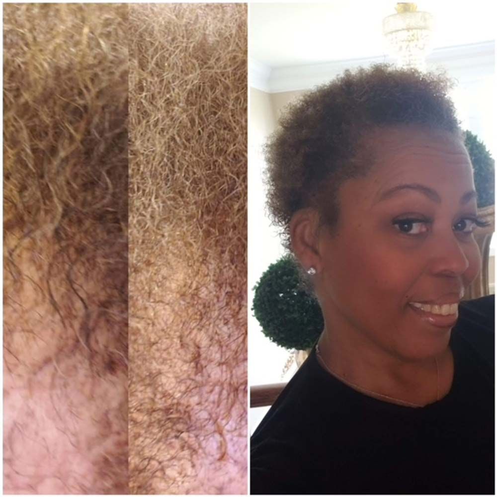 Hair Growth Results