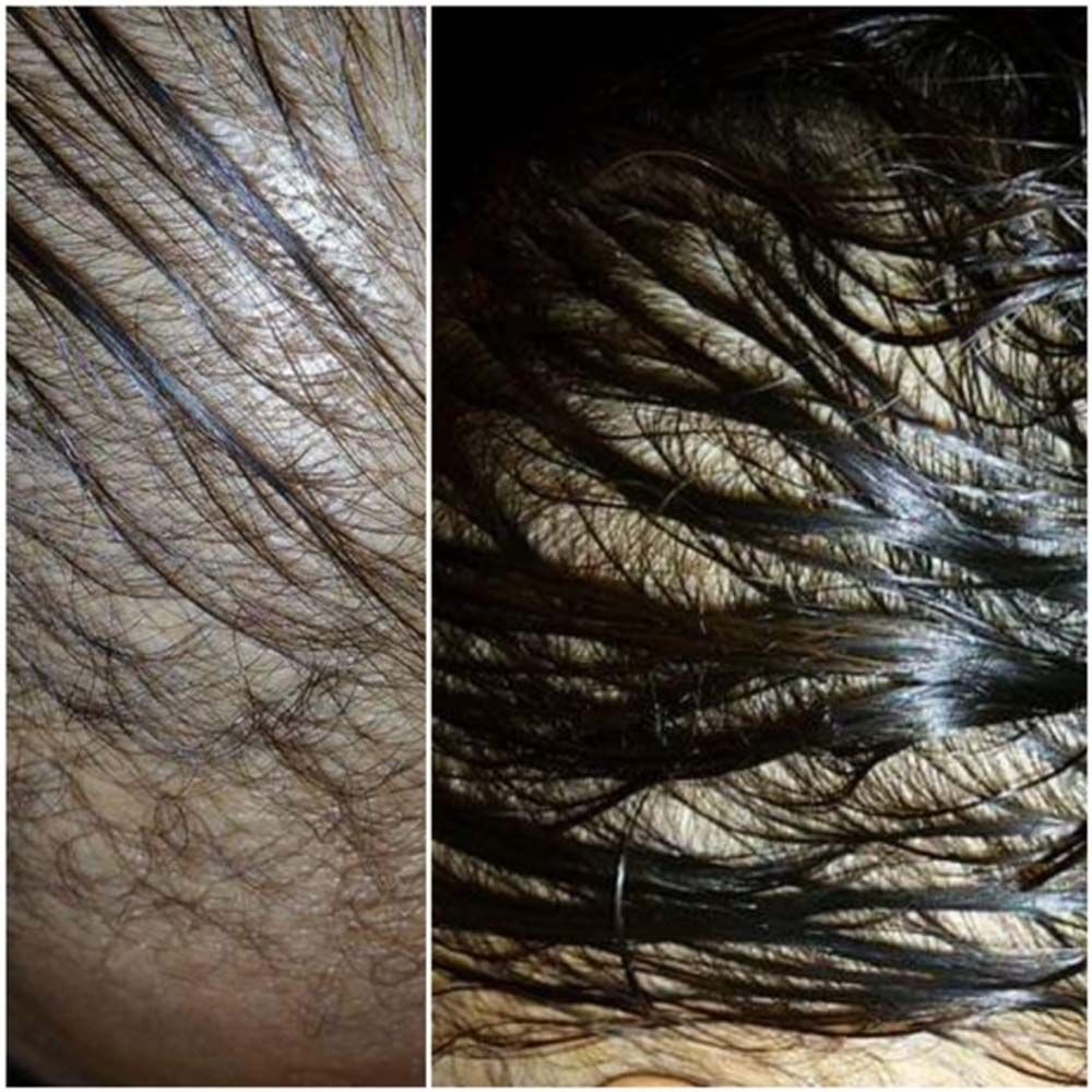 Hair Growth Results