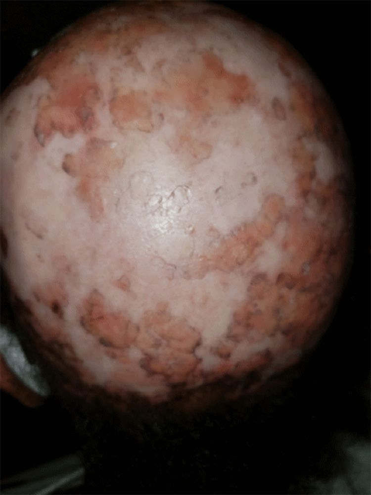 Lupus