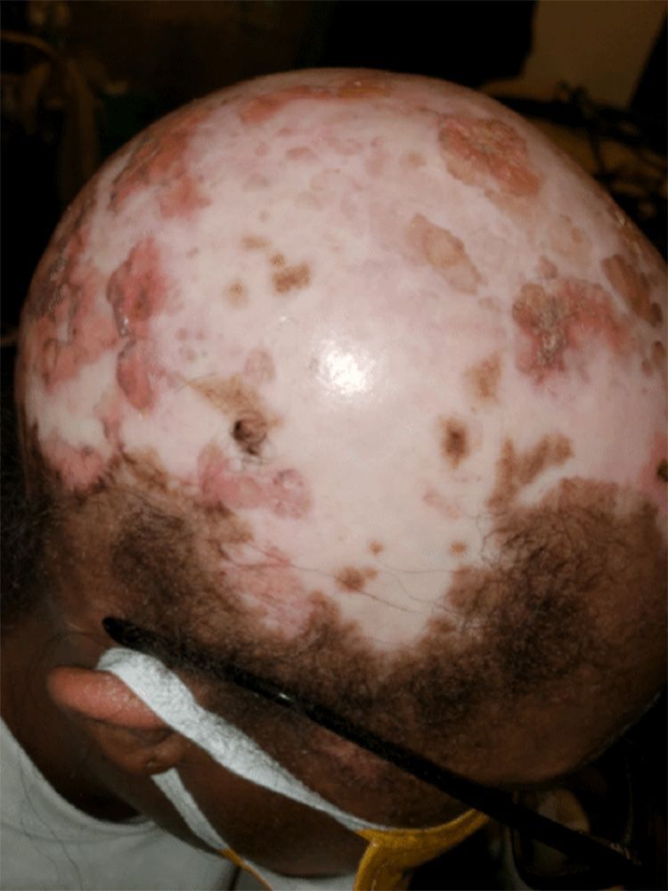 Lupus