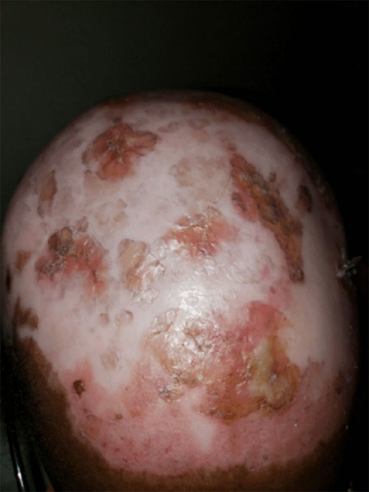 Lupus