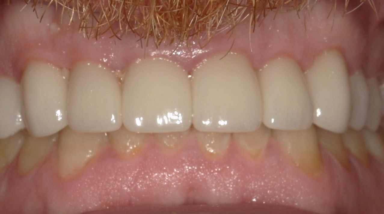 A close up of a man 's teeth with a beard.