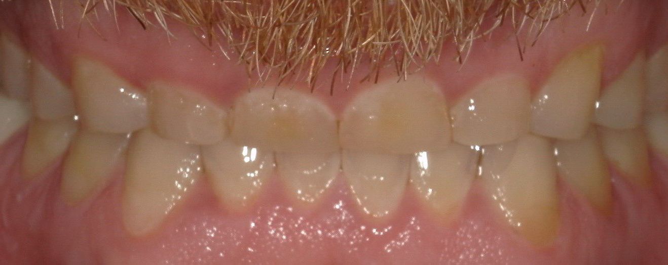 A close up of a man 's teeth with a beard.