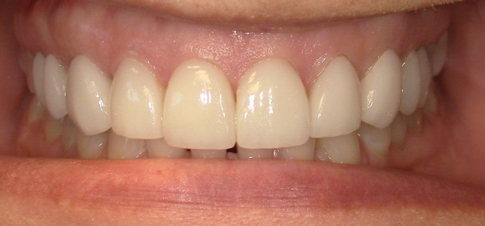 Close-up of a mouth with a full set of white teeth, showing gums and inner cheek.