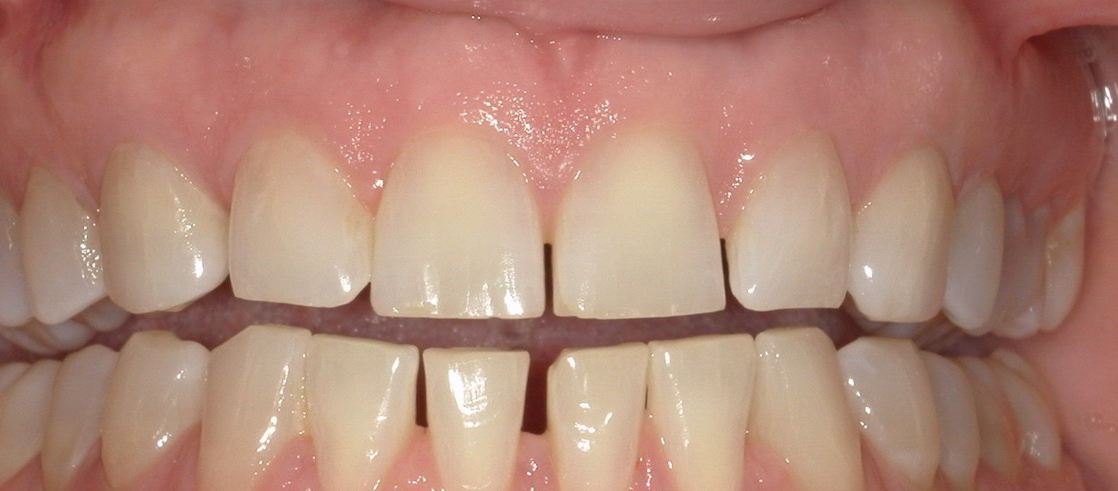 Close-up of teeth with slight discoloration and some small gaps between teeth.