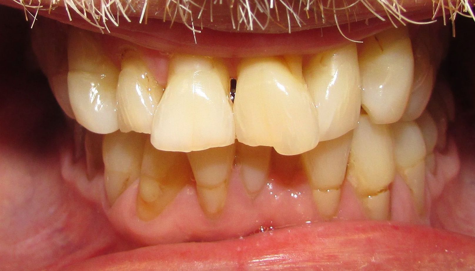 A close up of a person 's teeth with a beard.